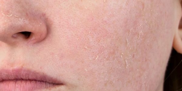 Tác hại của Retinol trên da nếu dùng không đúng cách