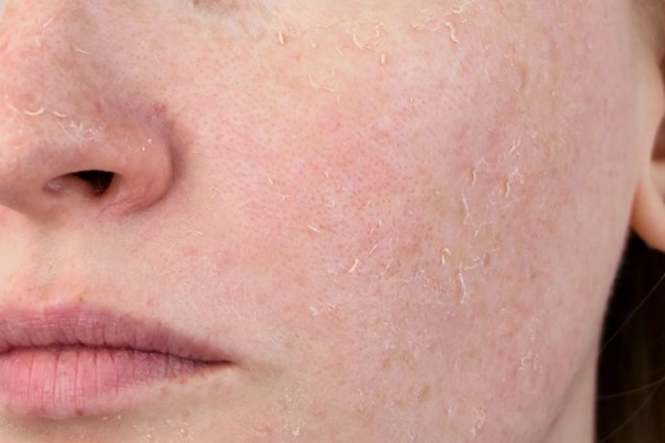 Tác hại của Retinol trên da nếu dùng không đúng cách